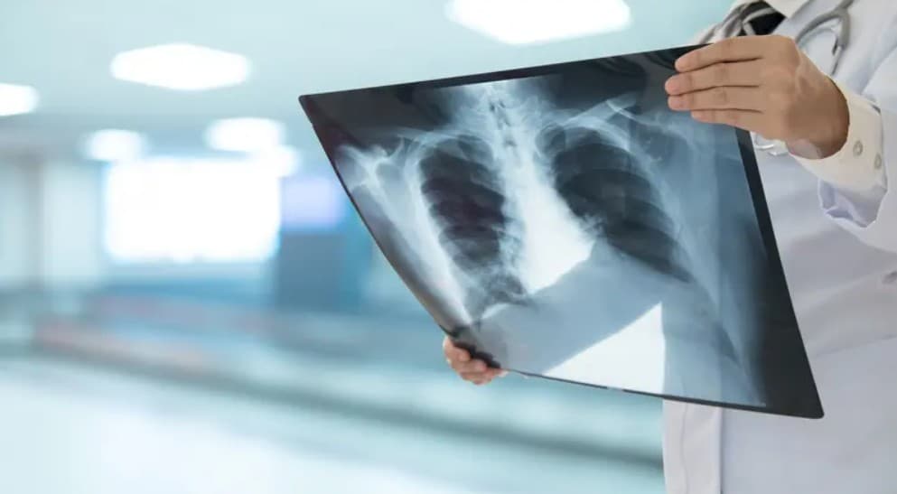 Genetic Insights into Non-Smoker Lung Cancer