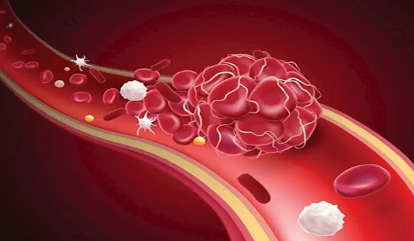 Study reveals molecule linked to blood clots