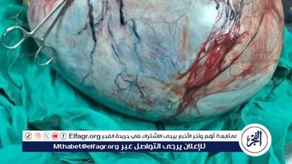 نجاح استئصال ورم عملاق يزن 24 كيلوجرامًا في مستشفى النساء والتوليد بجامعة المنيا