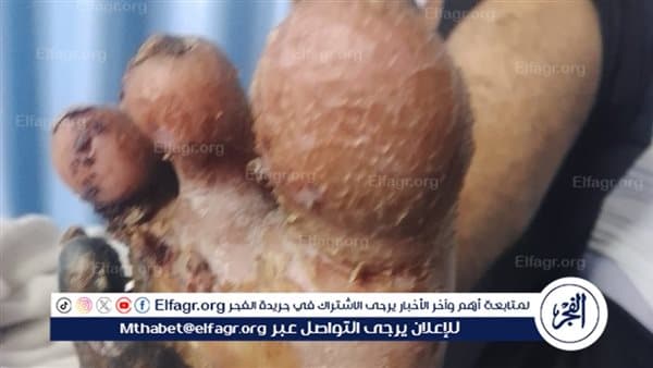مريض قدم سكري بالفيوم يتوجه لوزير الصحة بعد تأجيل جراحته مرتين رغم سداد الرسوم في المستشفى الجامعي