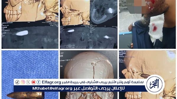Assiut Medical Team Saves Face Shooting Victim