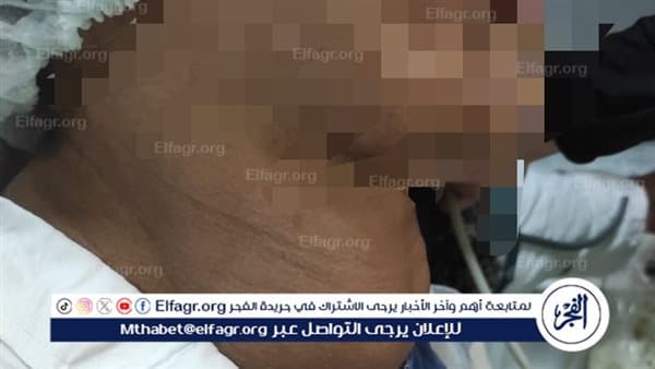 Fayoum woman's thyroid tumor removed sparing vocal nerve