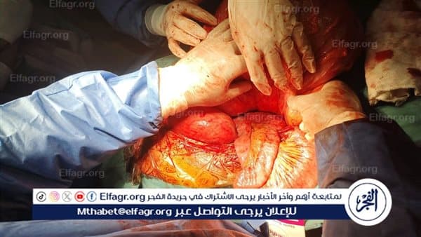 Assiut doctors treat severe diaphragmatic paralysis