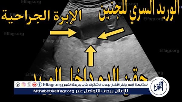 Uterine transfusions treat severe anemia at Assiut University