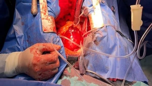 نجاح مستشفيات بني سويف في إنقاذ مريضة خلال عملية قلب معقدة