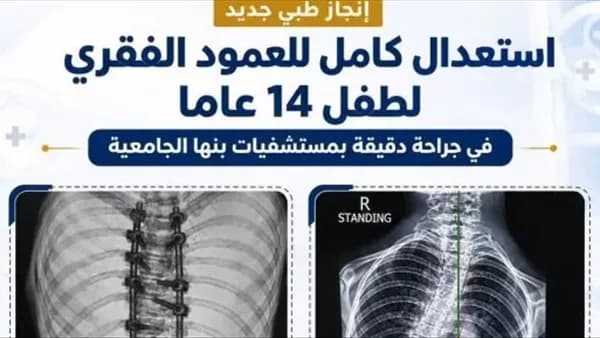 تصحيح كامل لعمود طفل في بنها