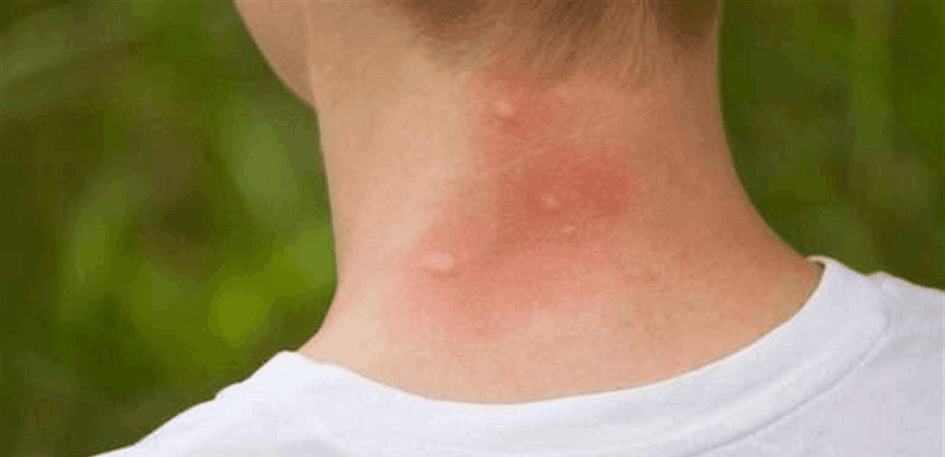 Italy faces viral outbreak amid rising temperatures