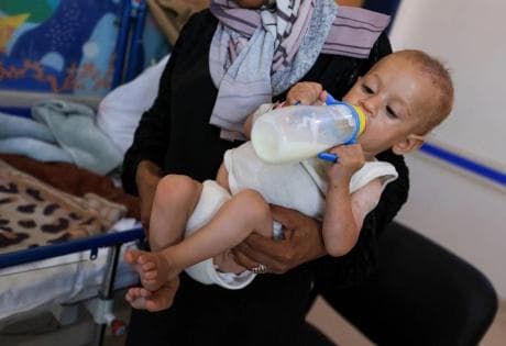طبيب في مجمع ناصر يحذر من سوء التغذية في غزة