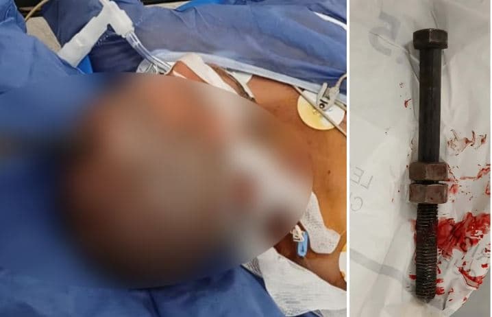 إجراء جراحي لاستخراج مسمار من جمجمة مريض