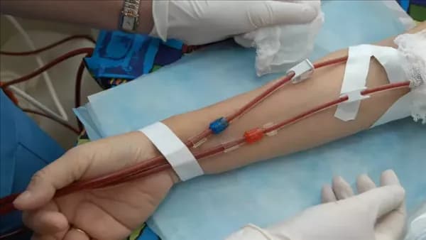 Health advises dialysis patients to report these symptoms