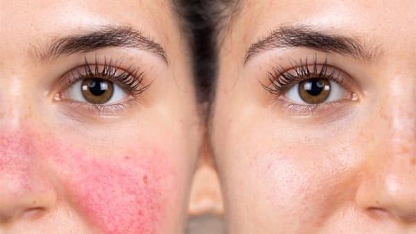 Home remedies for sun-exposed skin redness
