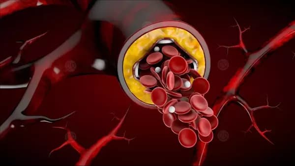 Indicators of high blood triglycerides