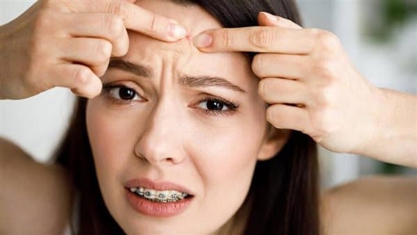 Fast Natural Ways to Treat Forehead Pimples