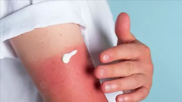 Sunscreen may not fully protect children