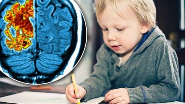 Study links childhood genetic disease to Alzheimer's