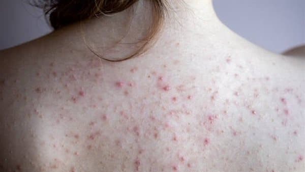 Create homemade soap for back acne
