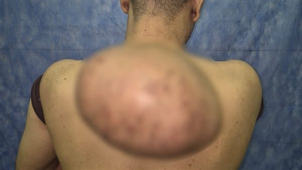 مستشفيات سوهاج تستئصل ورم دهني ضخم
