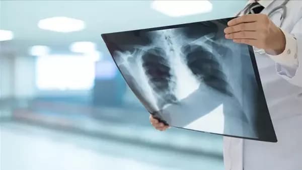 Genes reveal lung cancer in non-smokers