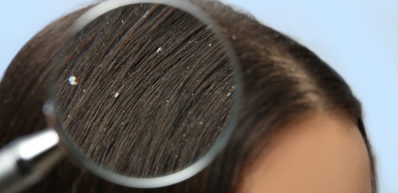 Treating dandruff with kitchen ingredients