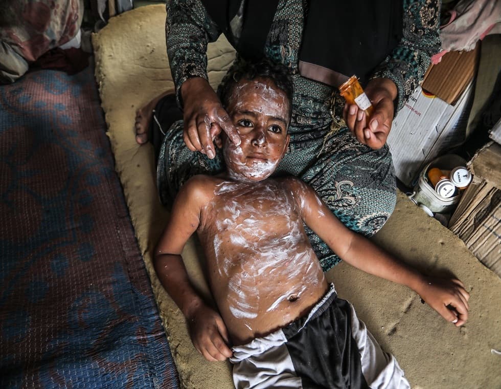 Gaza Reports Record Chickenpox Cases