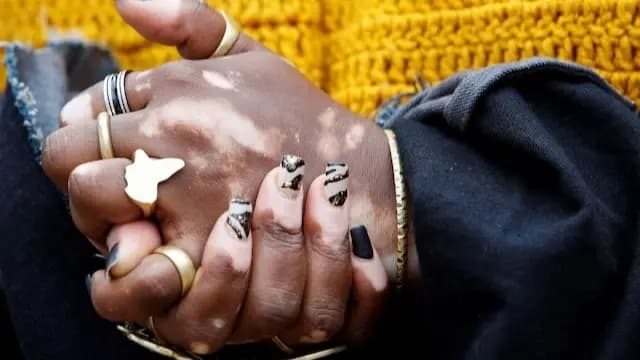 Study highlights vitiligo positive news