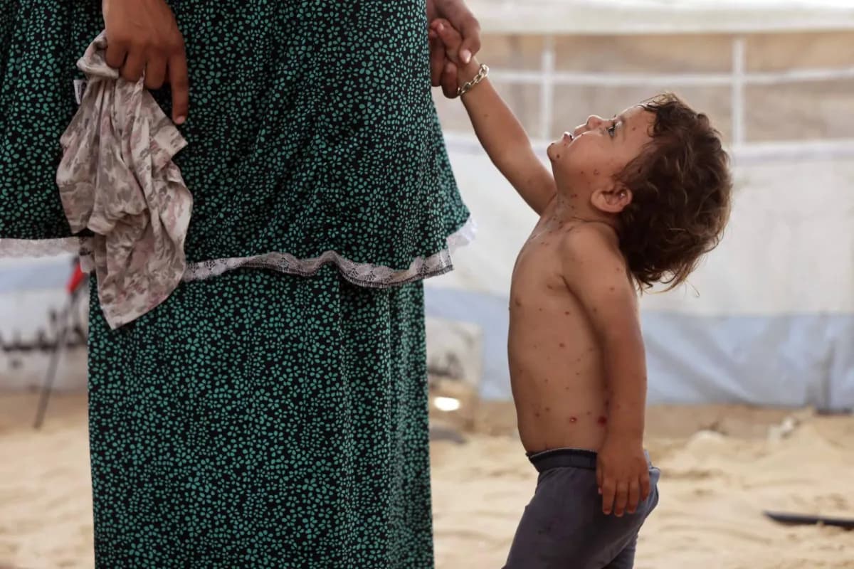 Gaza faces severe smallpox outbreak