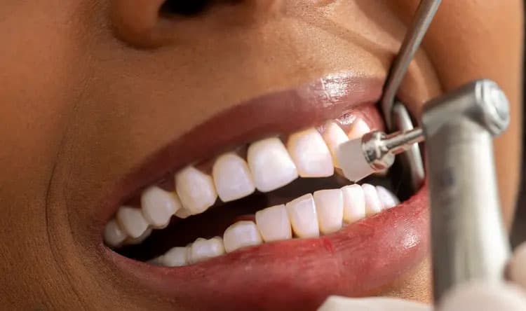 New Gel Rebuilds Tooth Enamel